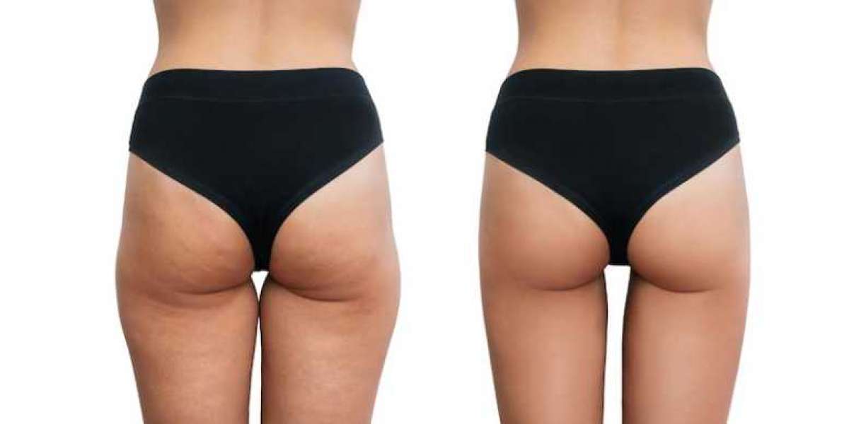 Top Pigmentation Treatments, Laser Hair Reduction, and BBL Surgery Options in Delhi: Costs, Benefits, and Expert Insight